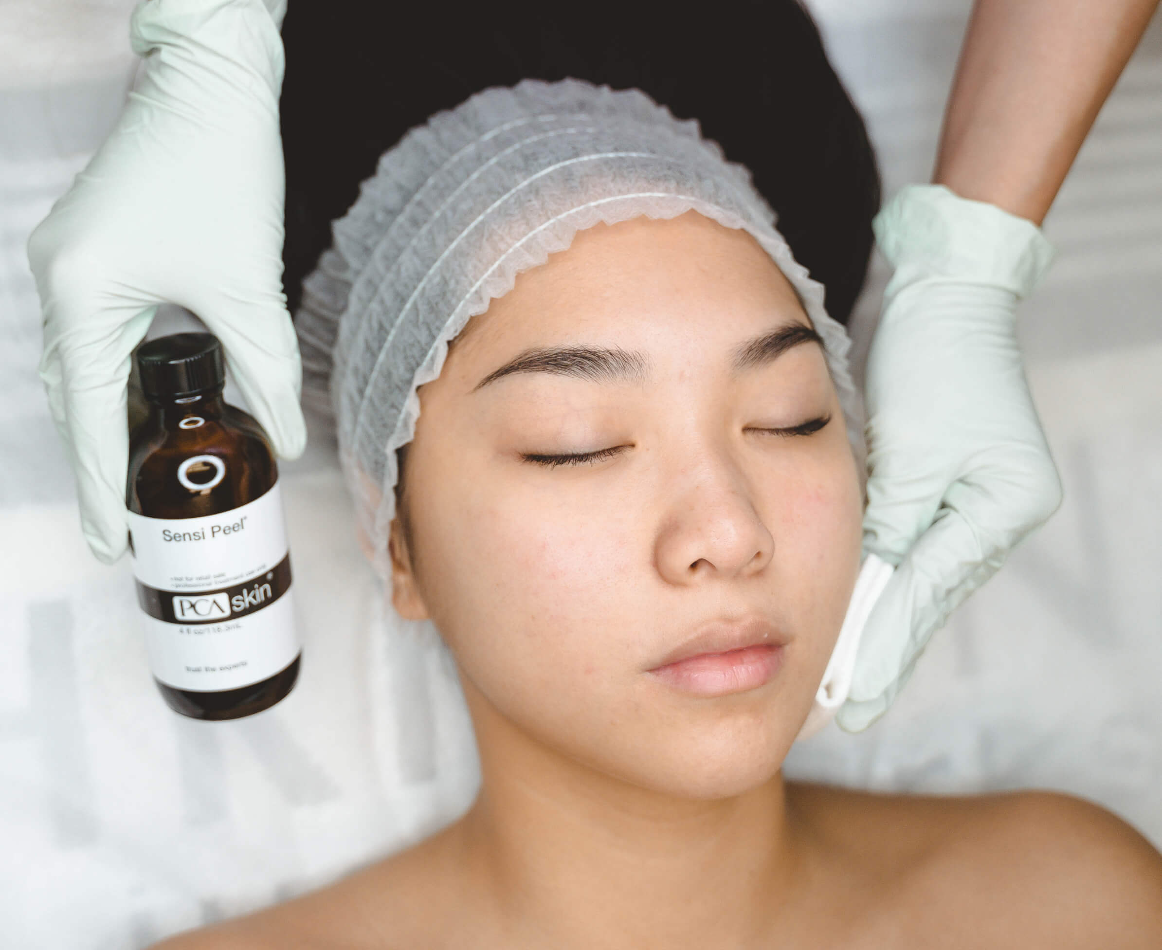 Chemical Peel